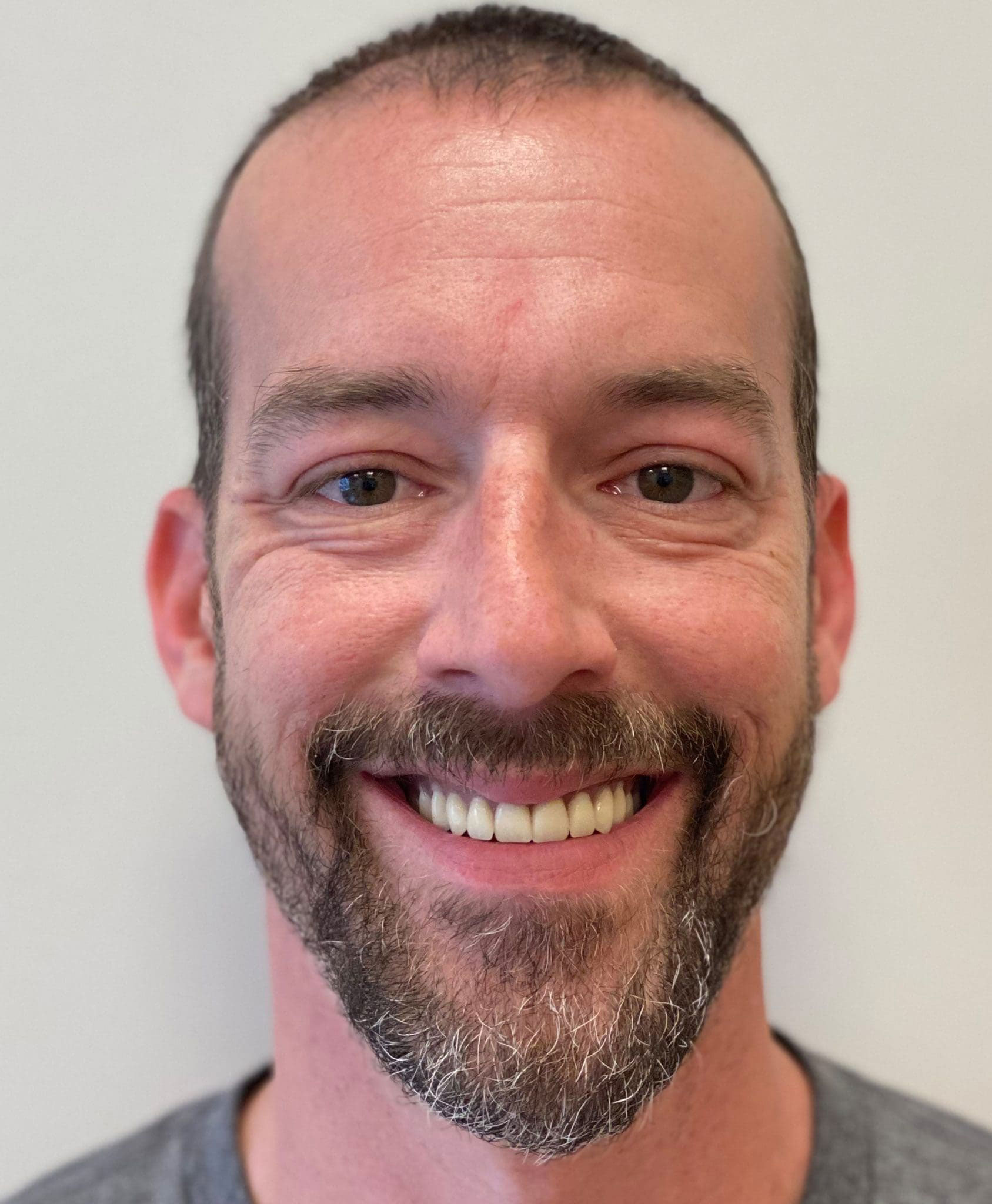 James denture results