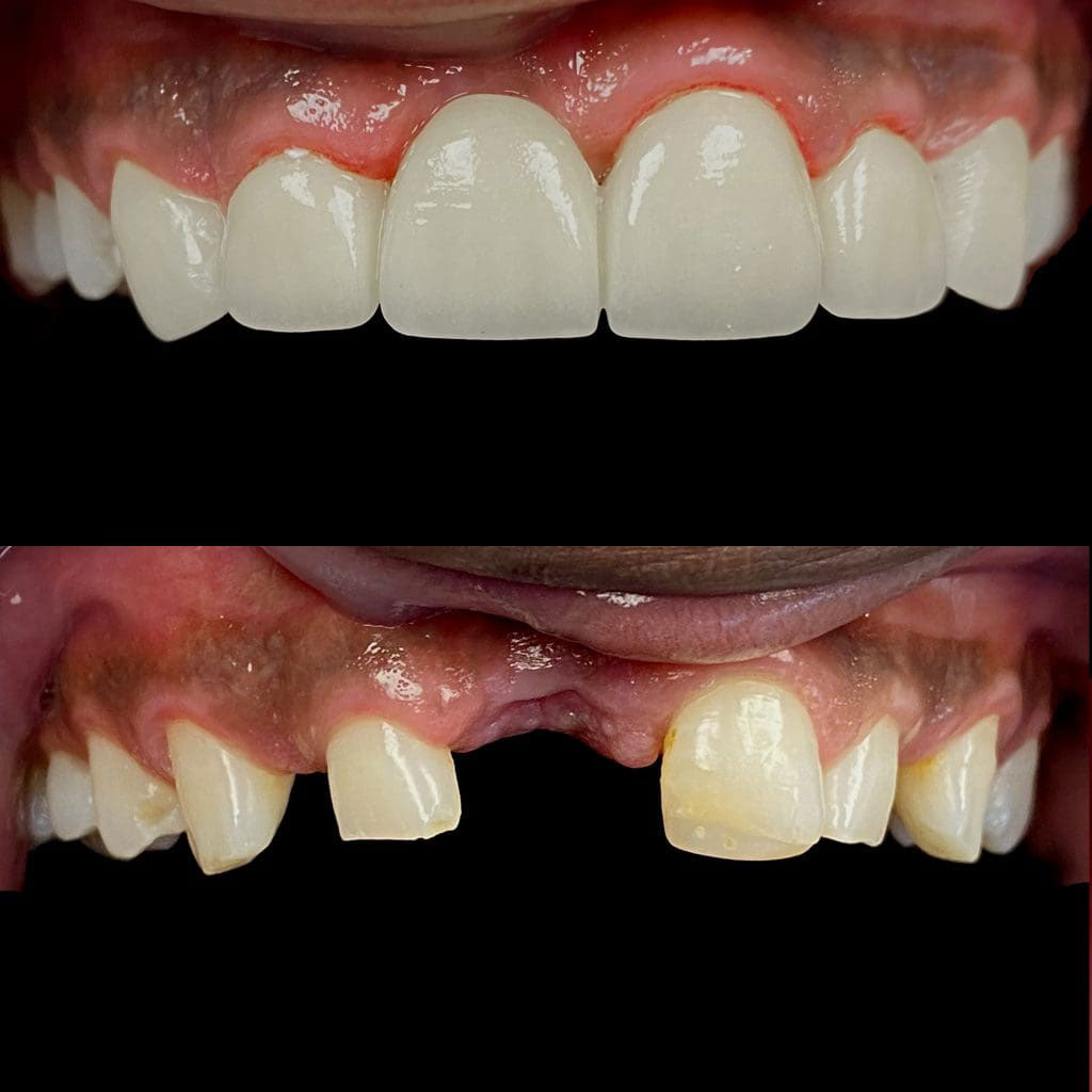 Restored crowns smile